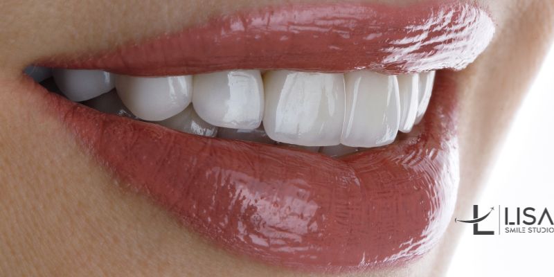 Hollywood Smile Costs in Turkey