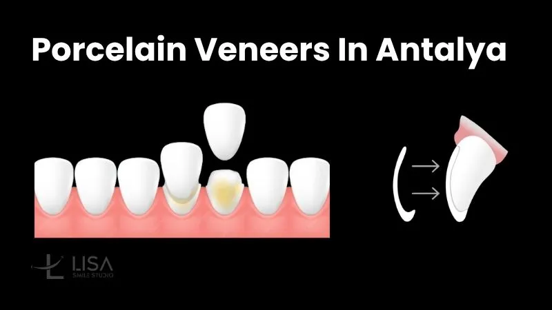 Porcelain veneers teeth in Antalya